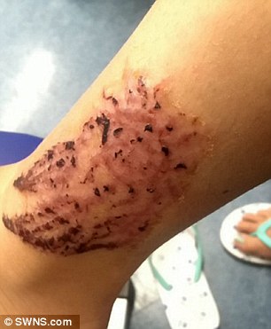 black henna injury